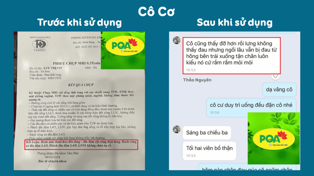 Feedback trước sau xương khớp viên nang 