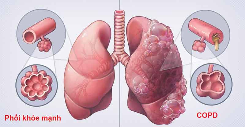 Bệnh phổi tắc nghẽn mạn tính COPD