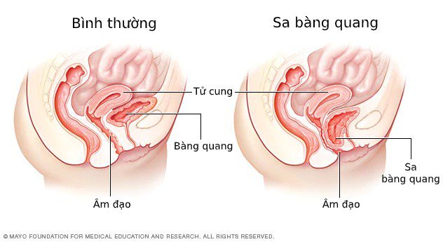 Điều trị Sa tử cung