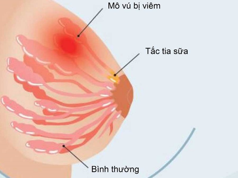 Tắc tia sữa