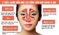 Triệu chứng viêm mũi dị ứng