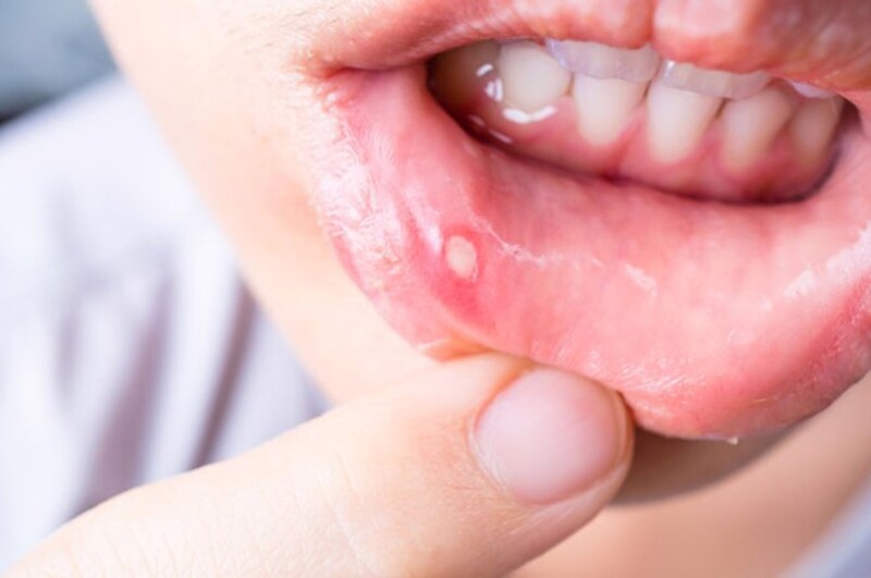 khắc phục nhiệt miệng