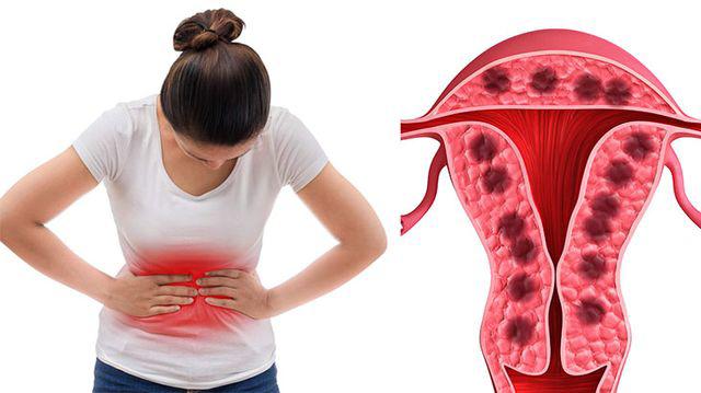 kinh nguyệt không đều, đau bụng kinh