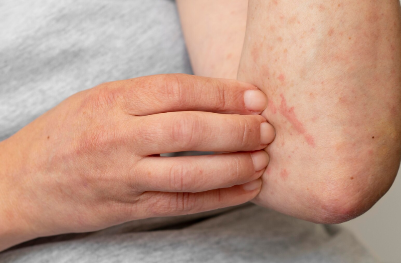 mẩn ngứa- triệu chứng tình trạng nóng gan