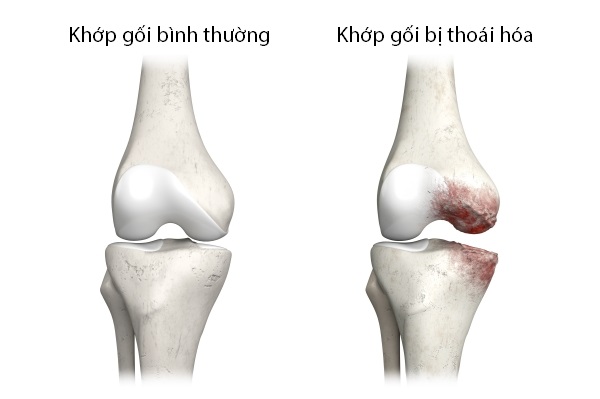 Khớp gối là một trong những vị trí dễ bị thoái hóa nhất
