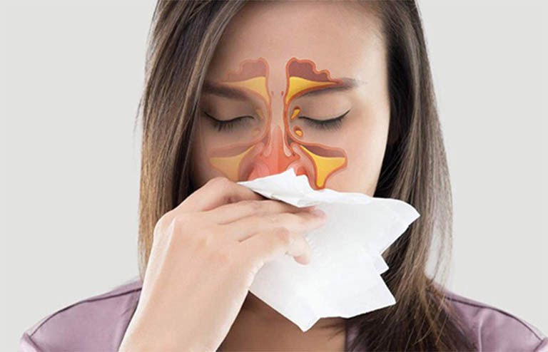 Viêm mũi dị ứng