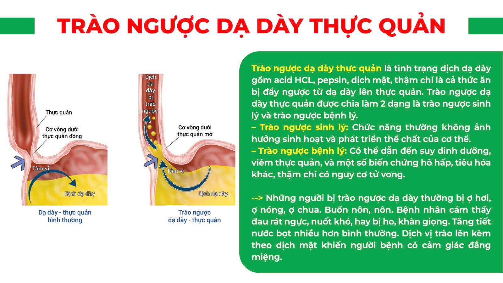 Trào ngược dạ dày