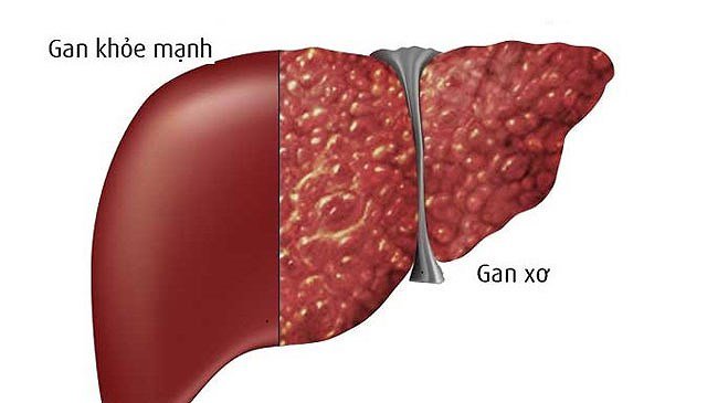 Dấu hiệu nhận biết xơ gan
