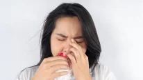 chảy máu cam