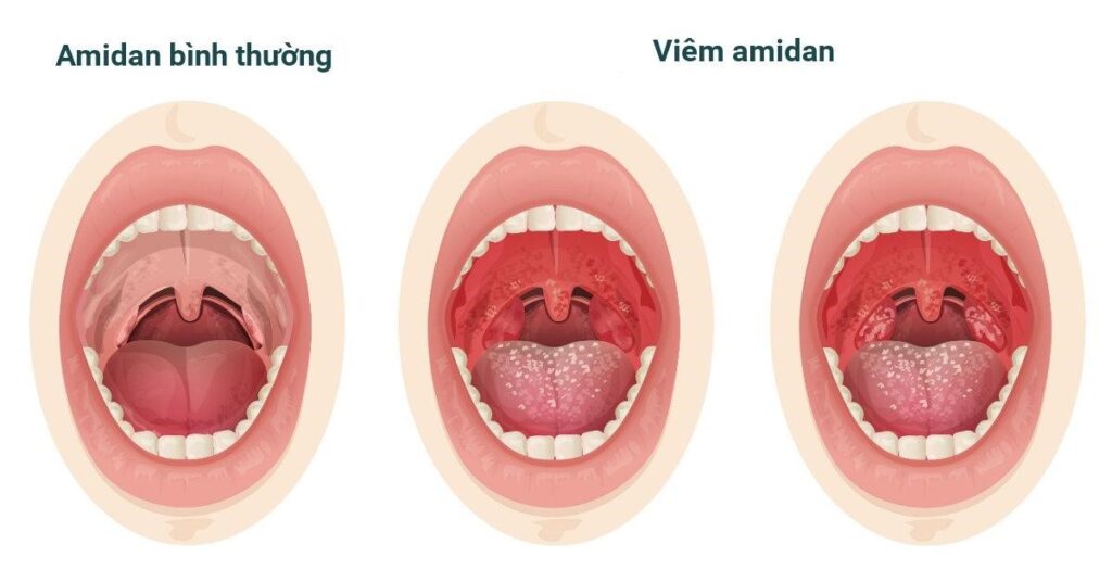 Viêm amidan
