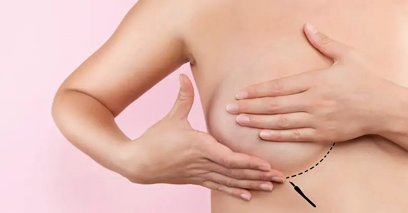 cách xử lý khi bị tắc tia sữa 