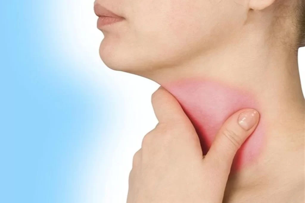 Viêm họng kéo dài