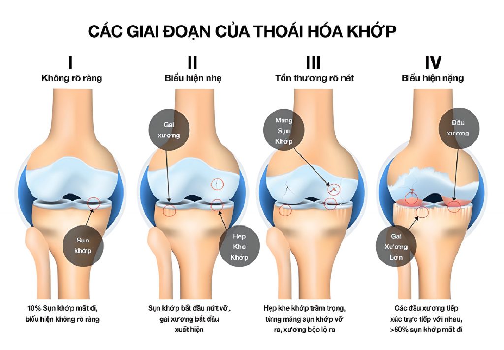 thoái hoá khớp 