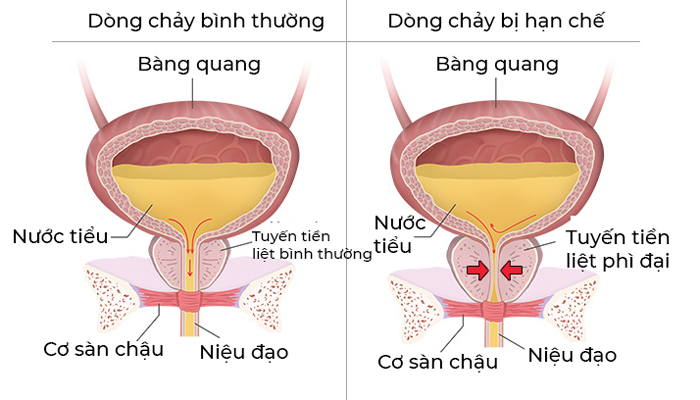 bí tiểu 