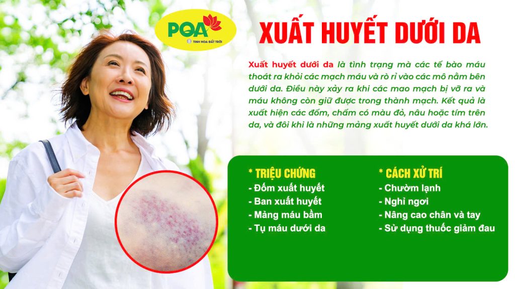 Nguyên nhân và triệu chứng xuất huyết dưới da